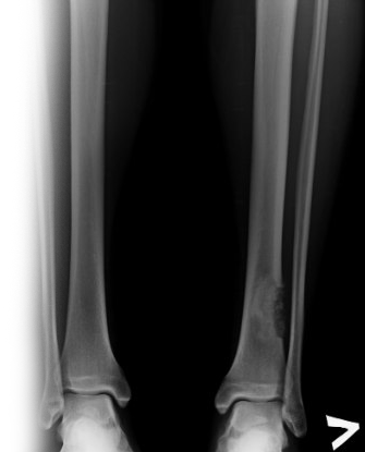Рентгенография берцовых костей