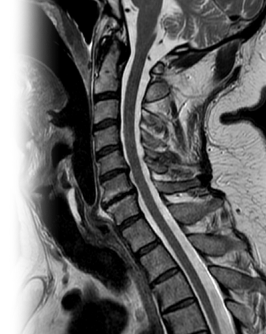 МРТ шейного отдела позвоночника