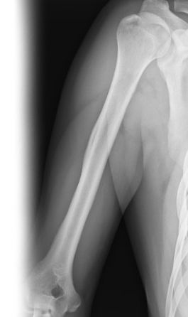 Рентгенография плечевой кости