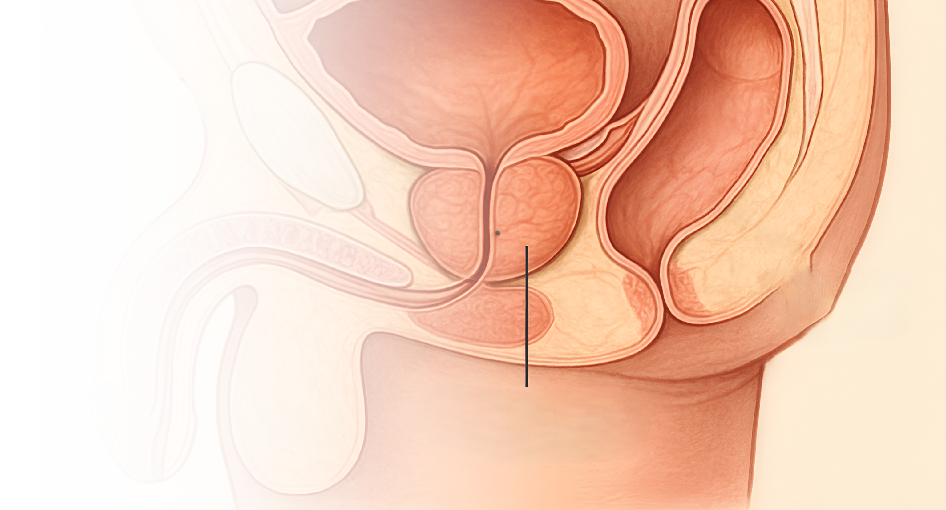 ТУР простаты