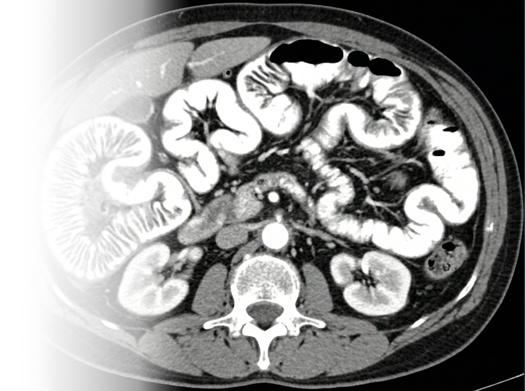 КТ энтерография с контрастированием