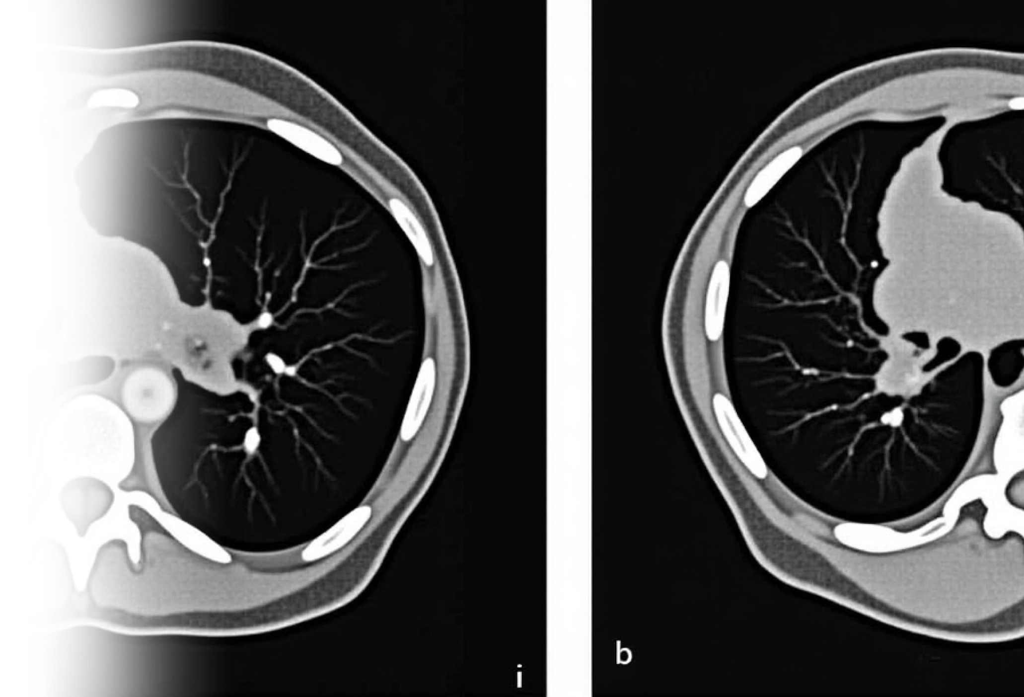 КТ органов грудной клетки