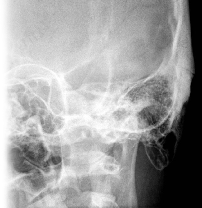 Рентгенография сосцевидных отростков