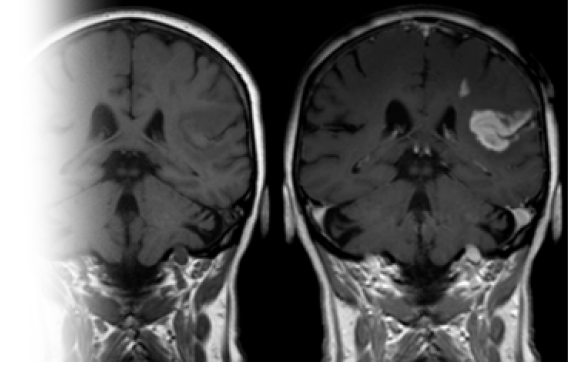 МРТ головного мозга с контрастом