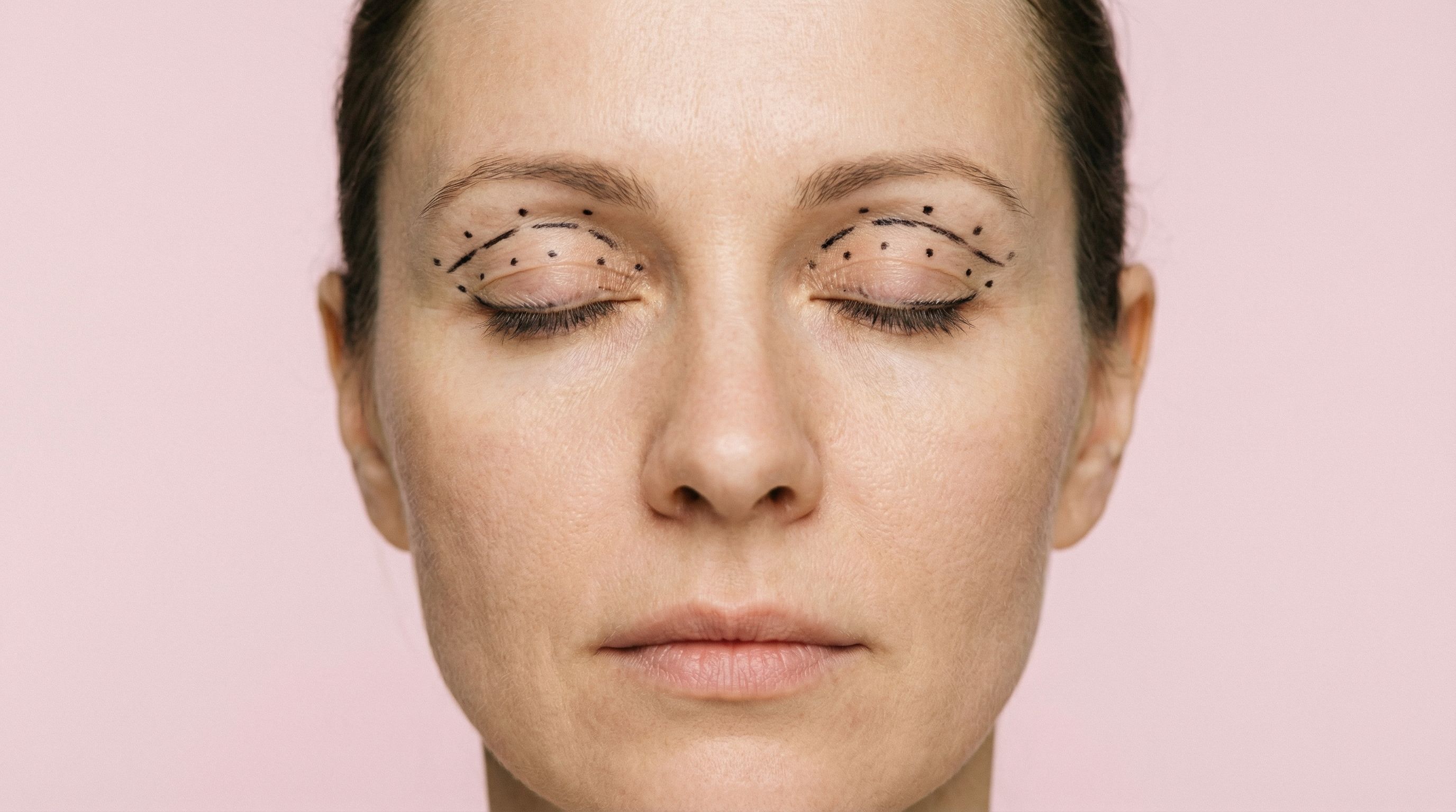 Верхняя блефаропластика “под ключ” со скидкой 20%