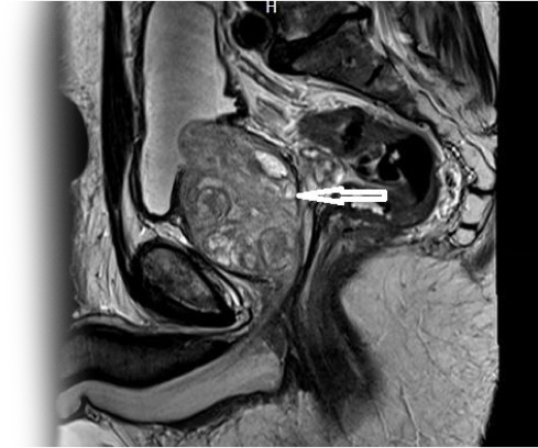 МРТ органов малого таза с контрастом
