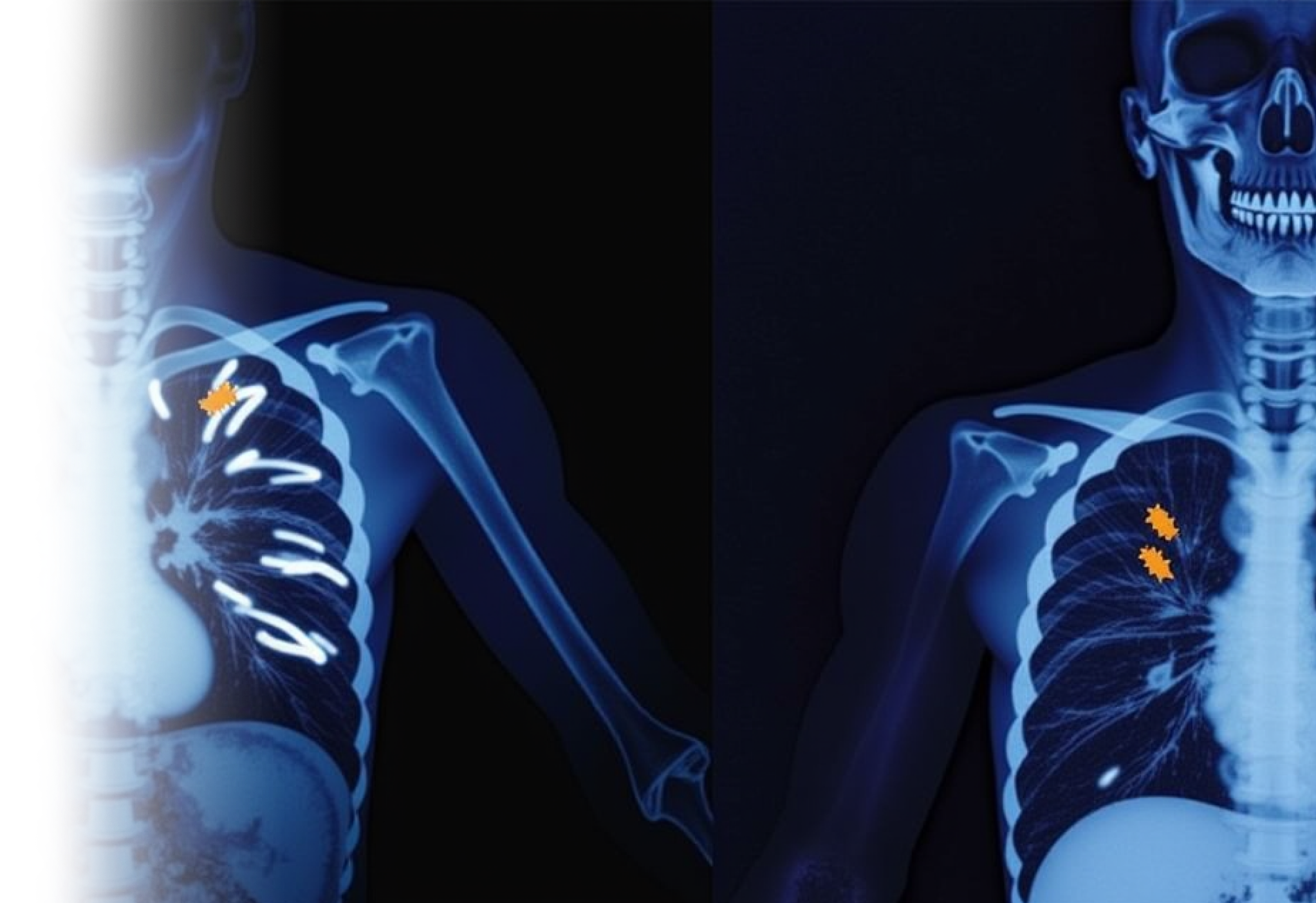 КТ органов грудной клетки с контрастированием