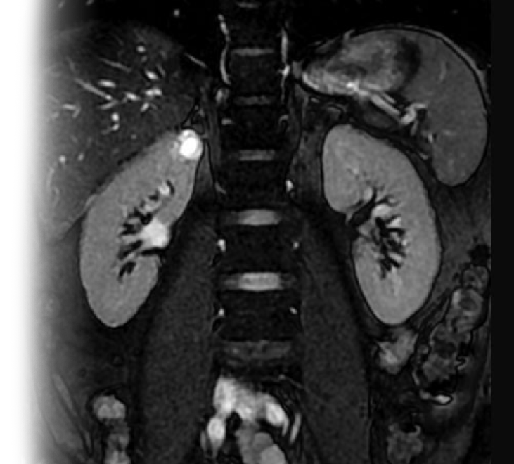 МРТ почек и надпочечников с контрастом