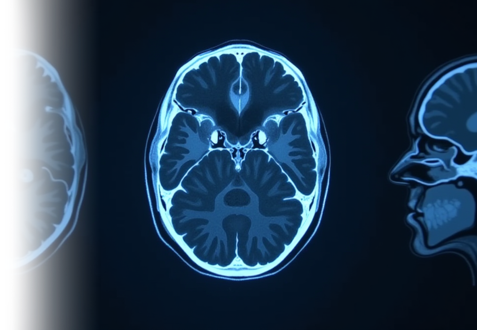 КТ головного мозга
