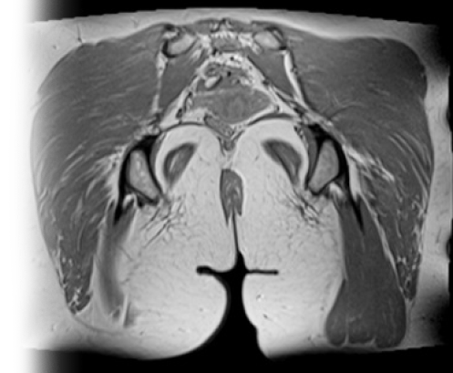 МРТ мягких тканей ягодичной зоны с контрастом