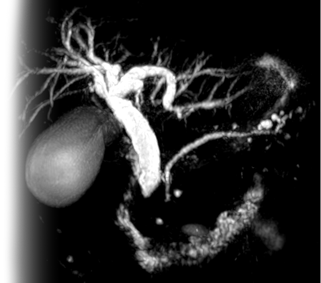 МР холангиография