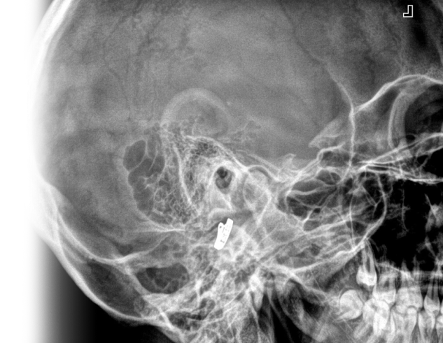 Рентгенография височных костей