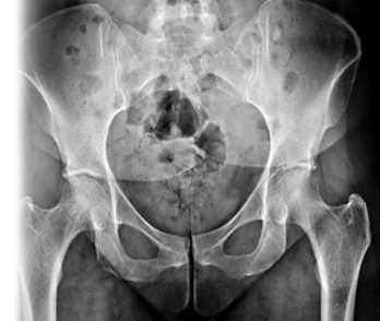 Рентгенография костей таза
