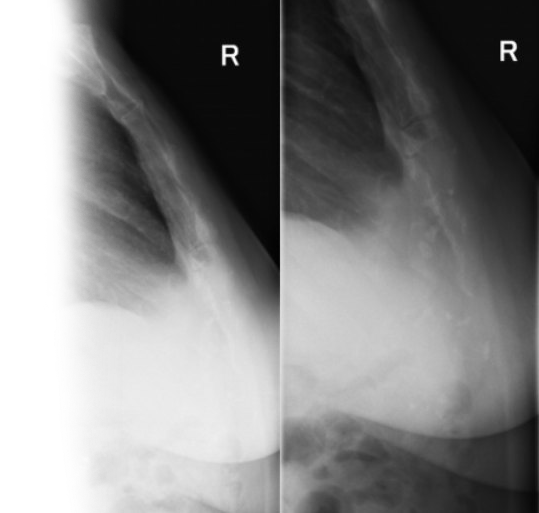 Рентгенография грудины