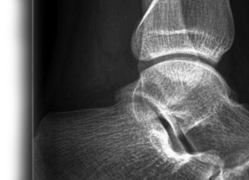 Рентгенография голеностопного сустава