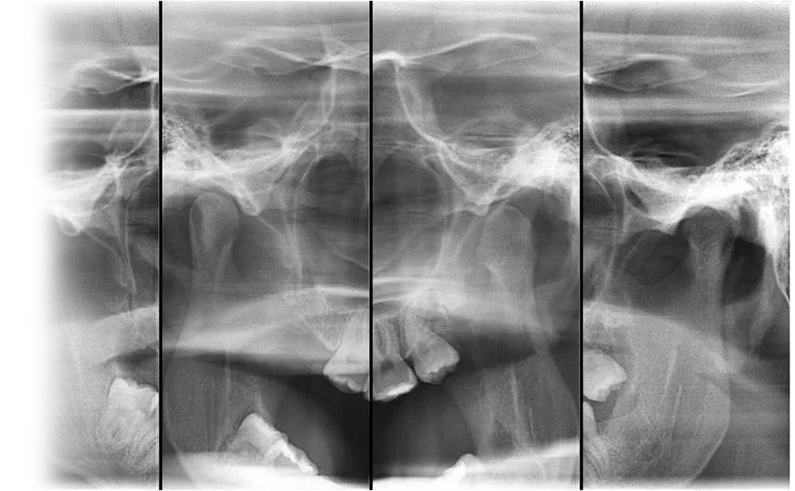 Рентгенография височно-нижнечелюстного сустава