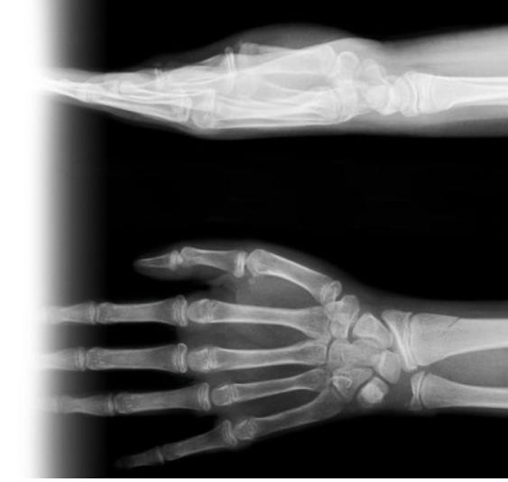 Рентгенография кисти