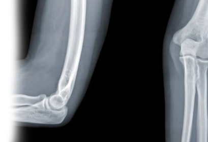 Рентгенография локтевого сустава