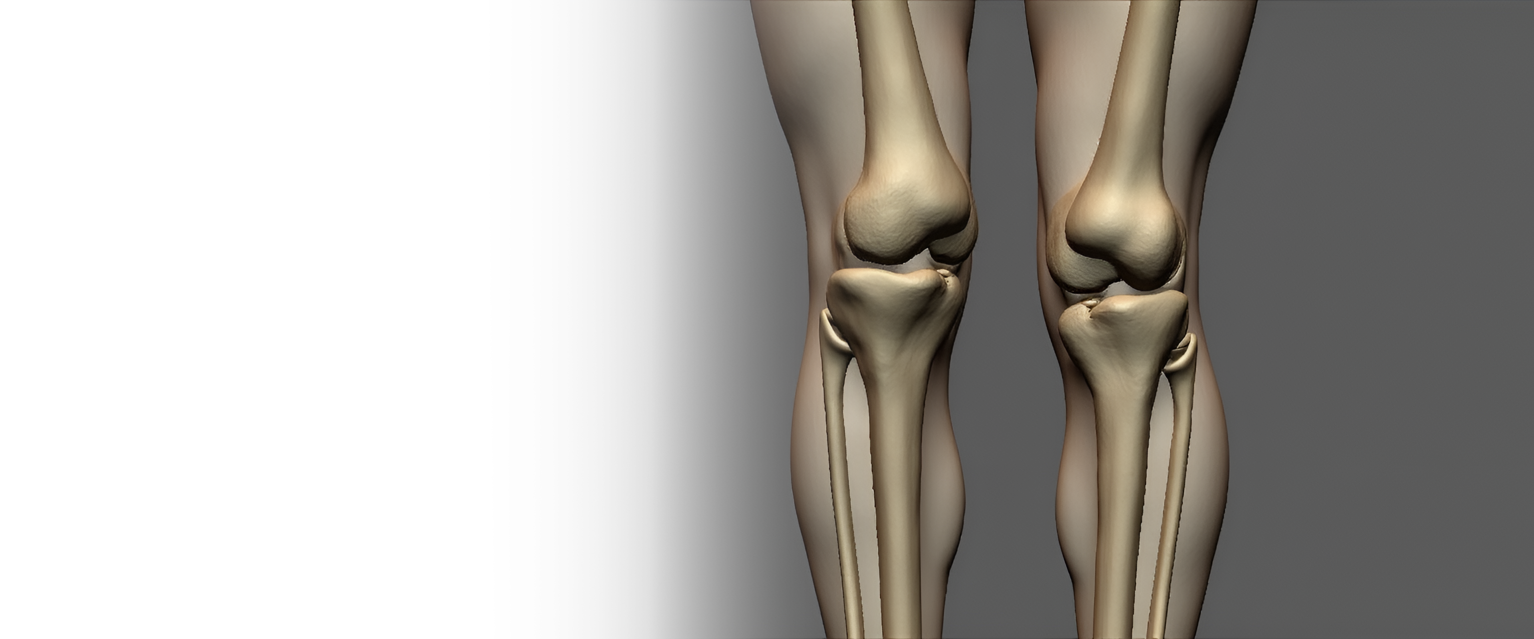 Артродез суставов