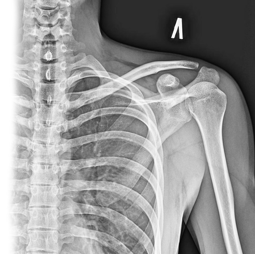Рентгенография лопатки