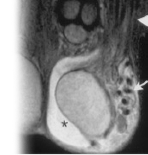МРТ наружных половых органов