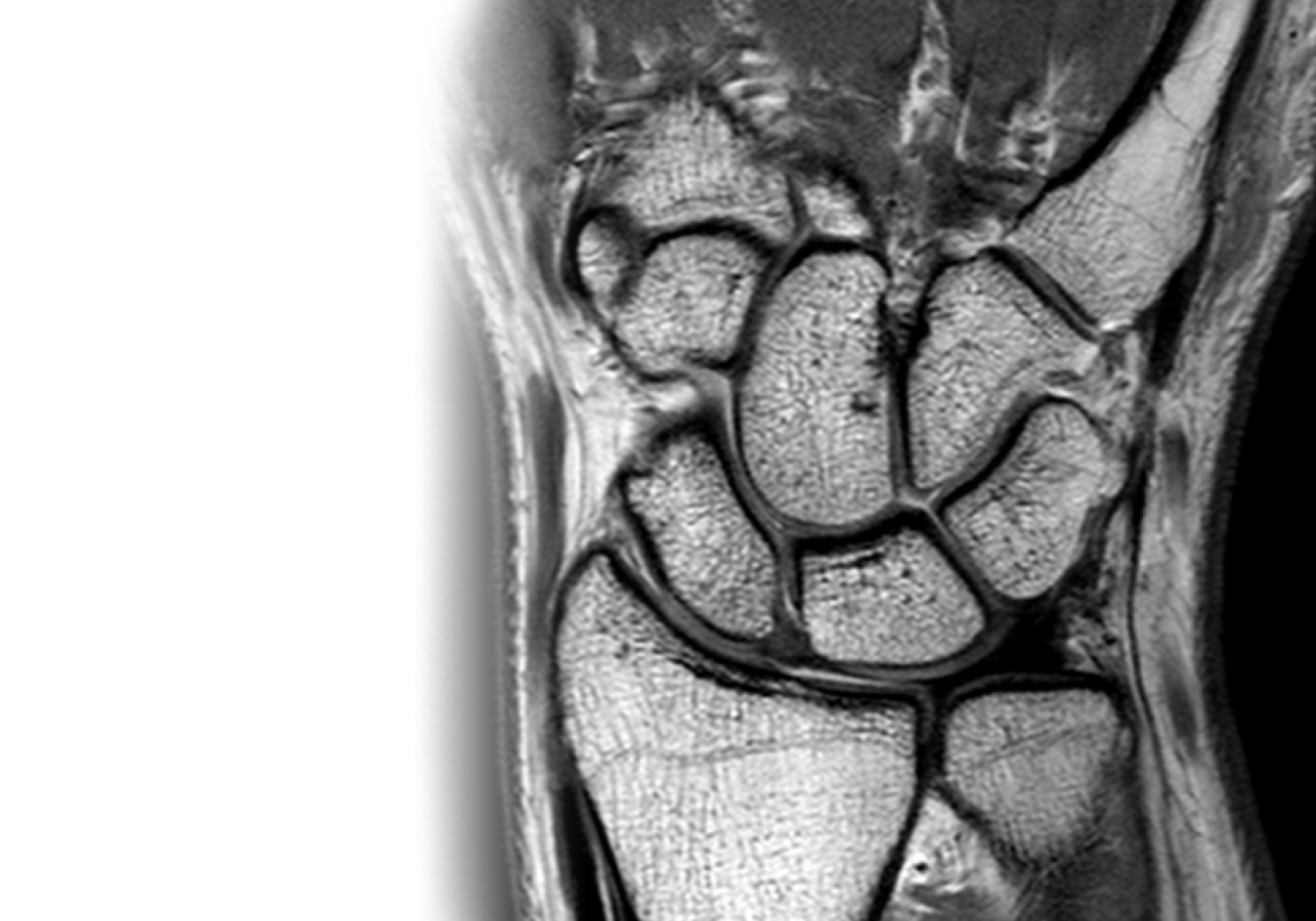МРТ лучезапястного сустава