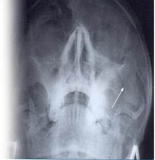 Рентгенография скуловой кости