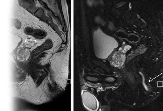 МРТ предстательной железы с динамическим контрастированием