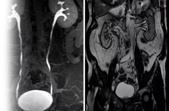 МРТ мочевыделительной системы с контрастной урографией