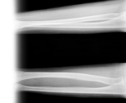 Рентгенография костей предплечья