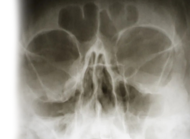 Рентгенография глазницы