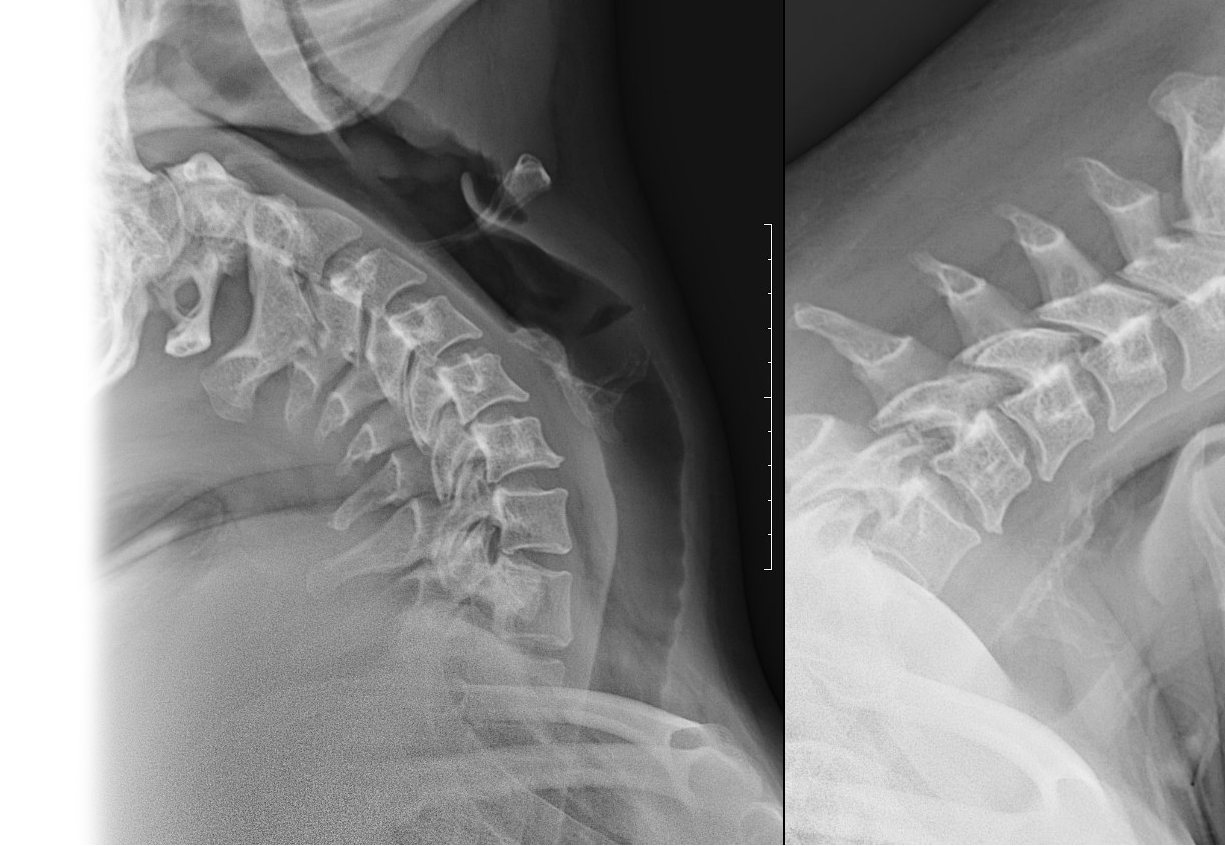 Рентгенография одного отдела позвоночника: функциональные пробы
