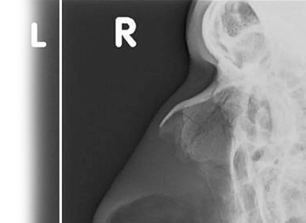 Рентгенография костей носа