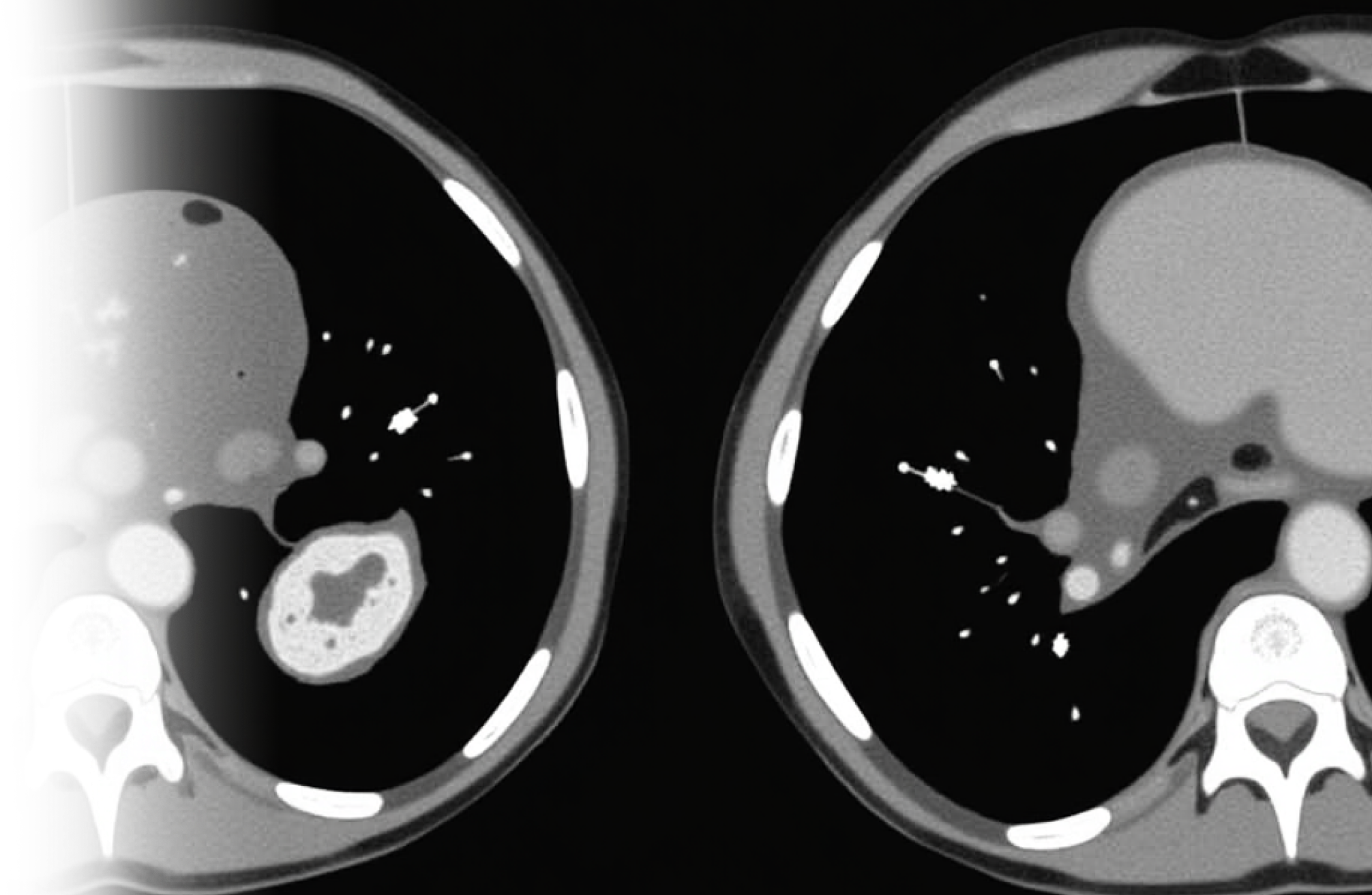КТ брюшной полости и забрюшинного пространства