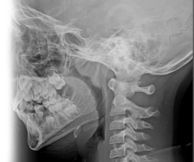 Рентгенография носоглотки