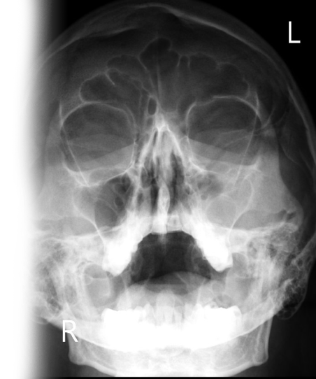 Рентгенография придаточных пазух носа
