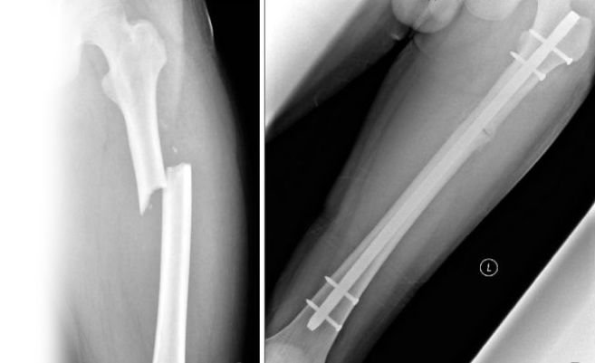 Рентгенография бедренной кости