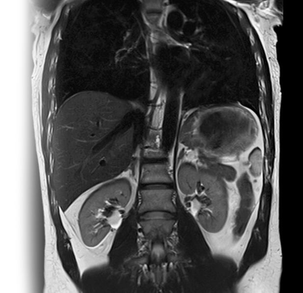 МРТ брюшной полости + МР холангиография с контрастом