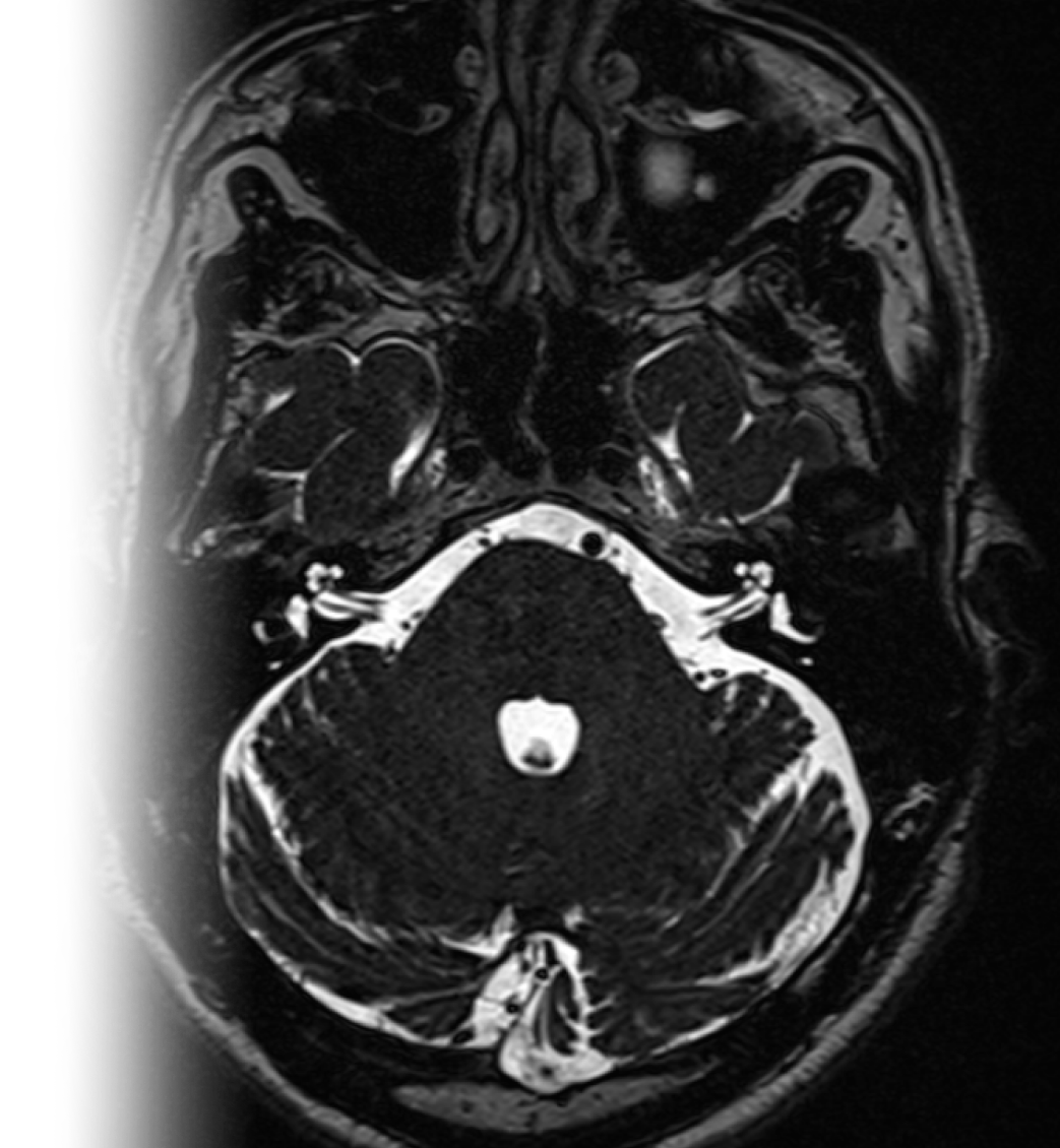 МРТ головного мозга при вазоневральном конфликте