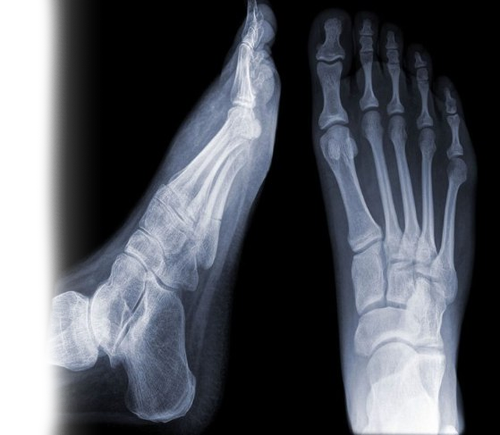 Рентгенография стопы