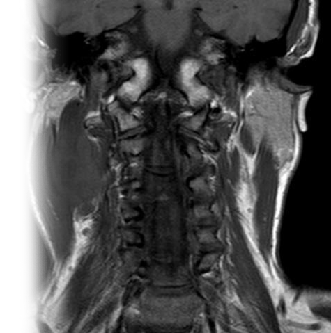 МРТ мягких тканей шеи с контрастом