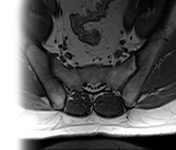 МРТ крестцово-подвздошных сочленений с контрастом