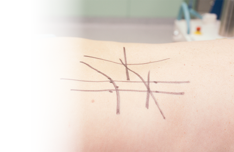 Рефлексотерапия