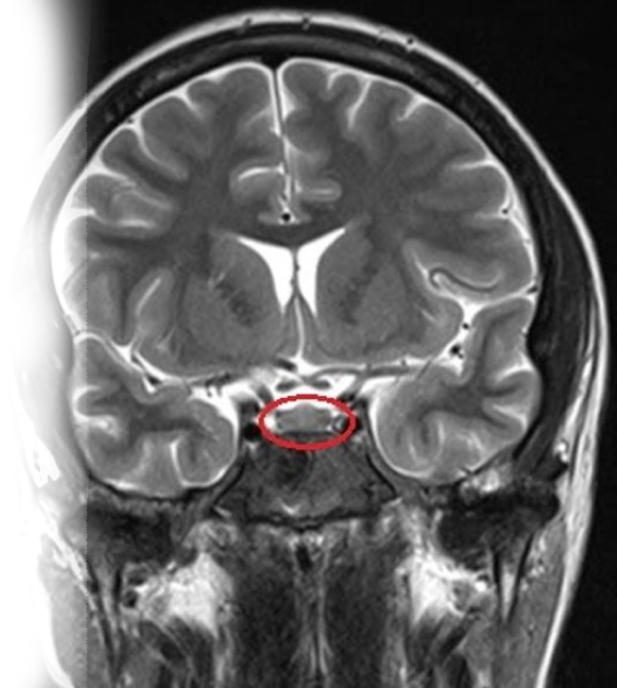 МРТ гипофиза с контрастом