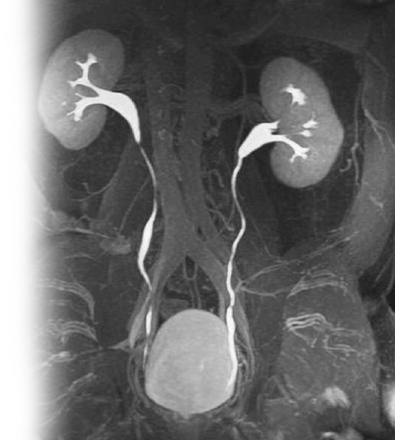 МР контрастная урография