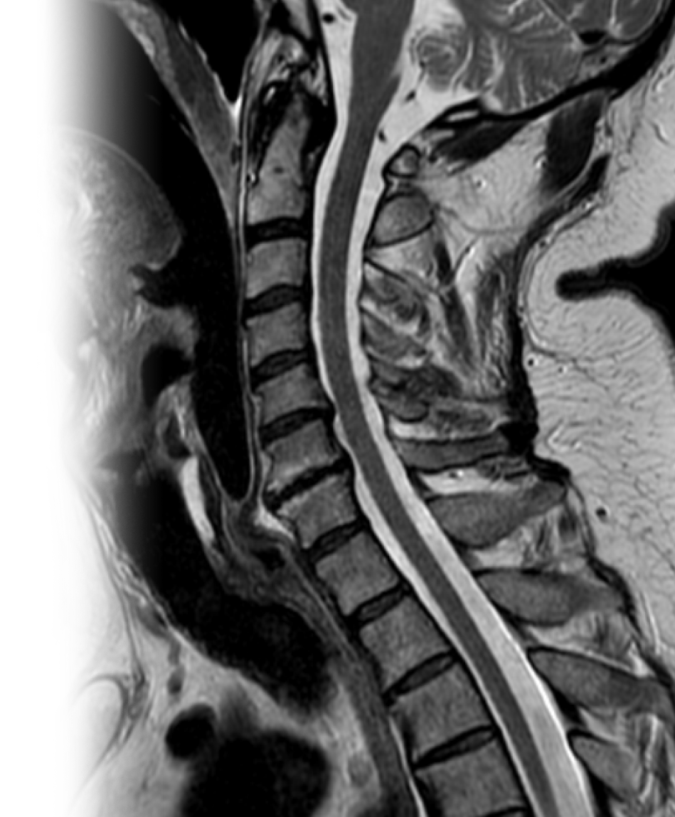 МРТ нескольких отделов позвоночника