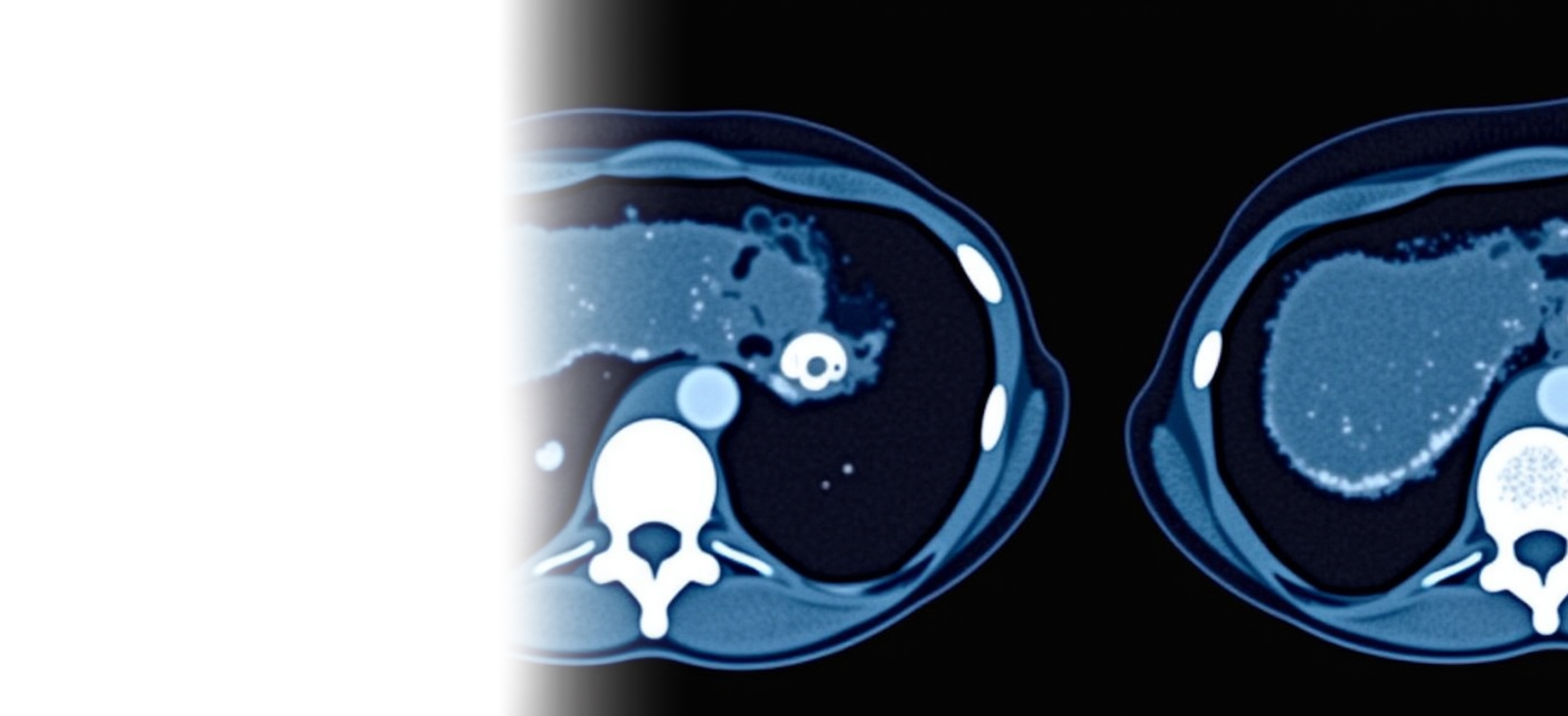 КТ брюшной полости и забрюшинного пространства с контрастированием