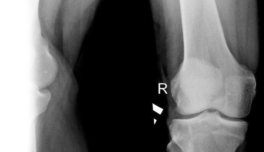 Рентгенография надколенника