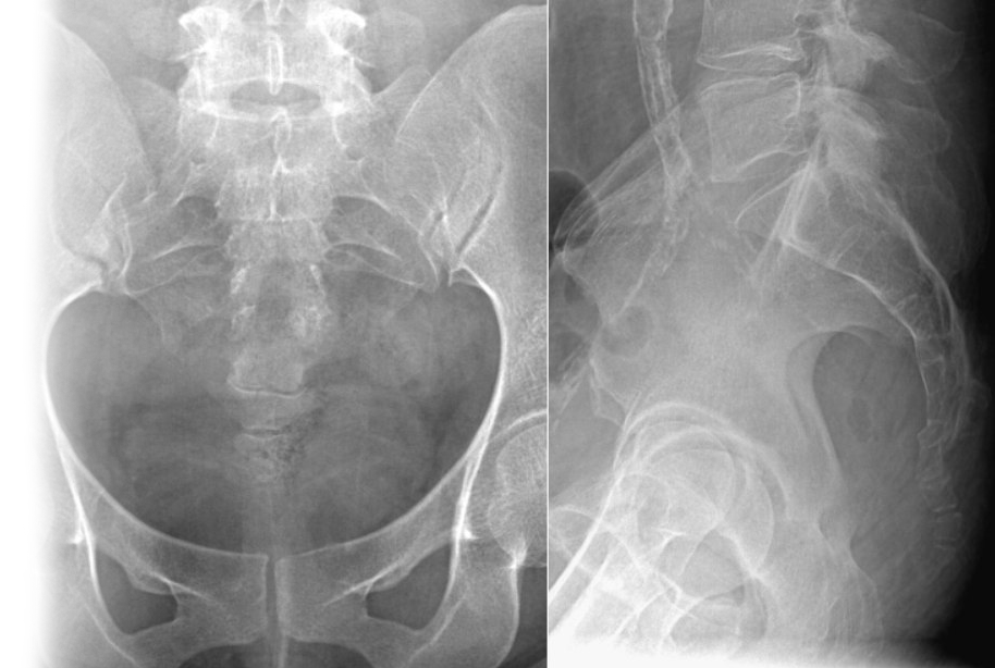 Рентгенография копчика