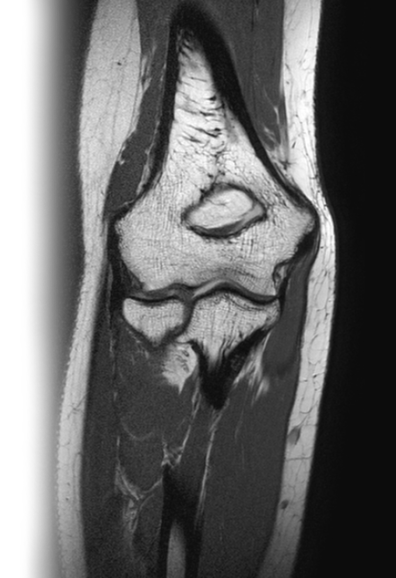 МРТ локтевого сустава